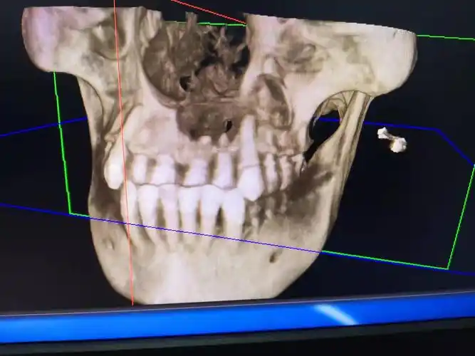 上颌骨口腔囊肿手术难做吗