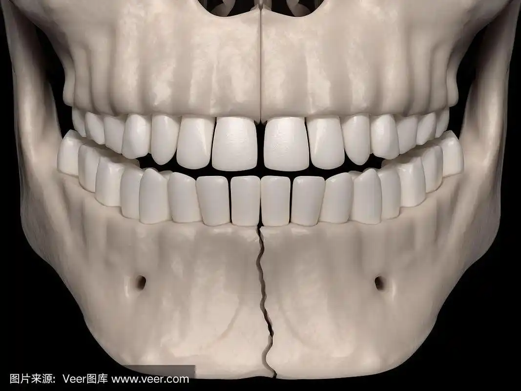 单纯联合骨折(下颌骨骨折)