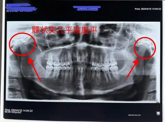 颞下颌关节保守治疗能让髁状突长回去吗?