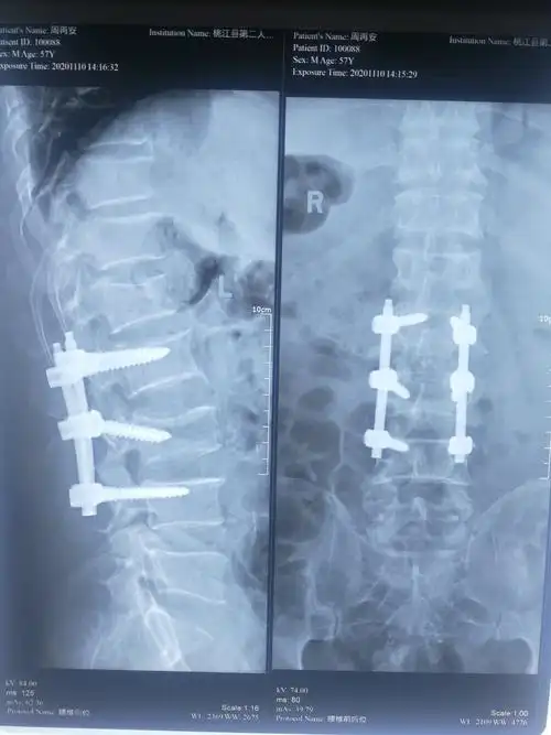 腰椎骨折钉棒系统内固定术