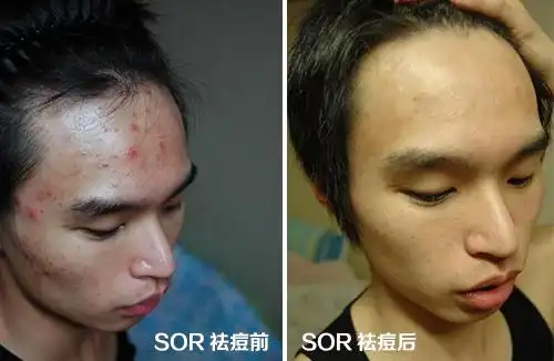 (高先生青春痘治疗前后对比图)