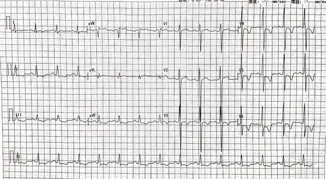 心肌病|心律失常|心电图_网易订阅