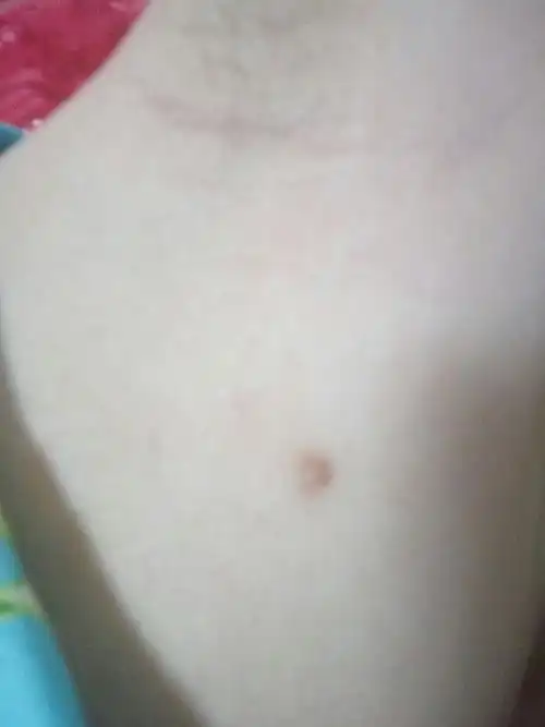 怀孕四个月腋窝长红疙瘩 ,一边一个!这是为什么?_百度宝宝知道