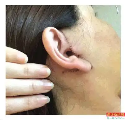 女子拉皮术后留下多条明显疤痕 该机构多次被行政处罚|口腔|手术|种牙