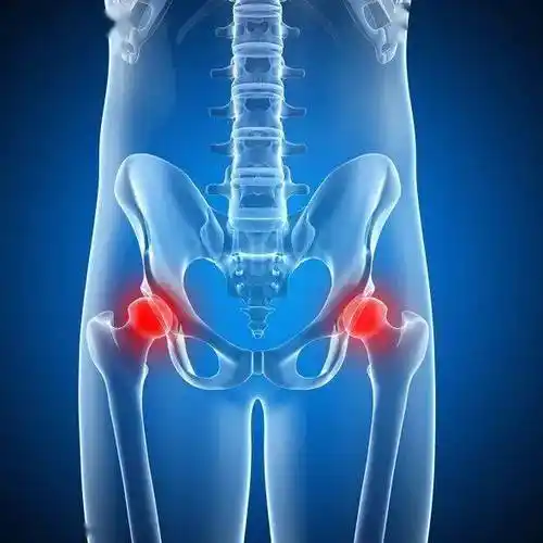 "孩子跛行大腿痛",警惕这个部位的滑膜炎!_髋关节_检查_积液