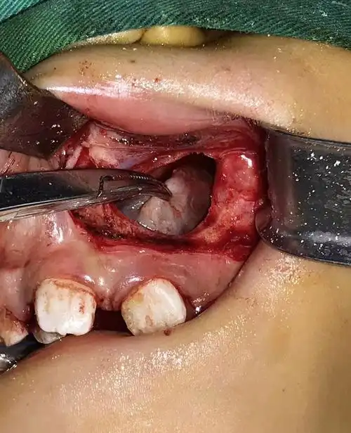 埋伏多生牙形成颌骨囊肿的微创外科治疗_颌骨囊肿_发病原因_治疗方式