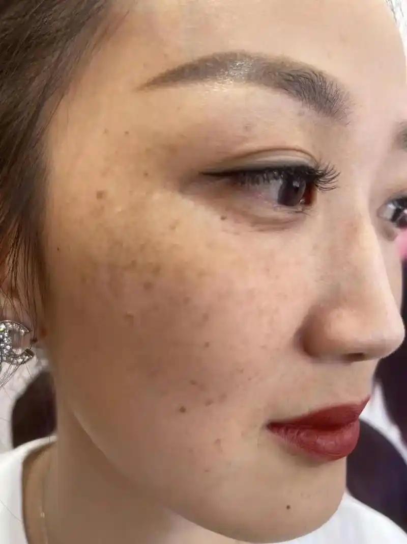 美女黄褐斑,生二胎斑更严重了,祛斑美天的变化效果,后期皮肤健 - 抖音