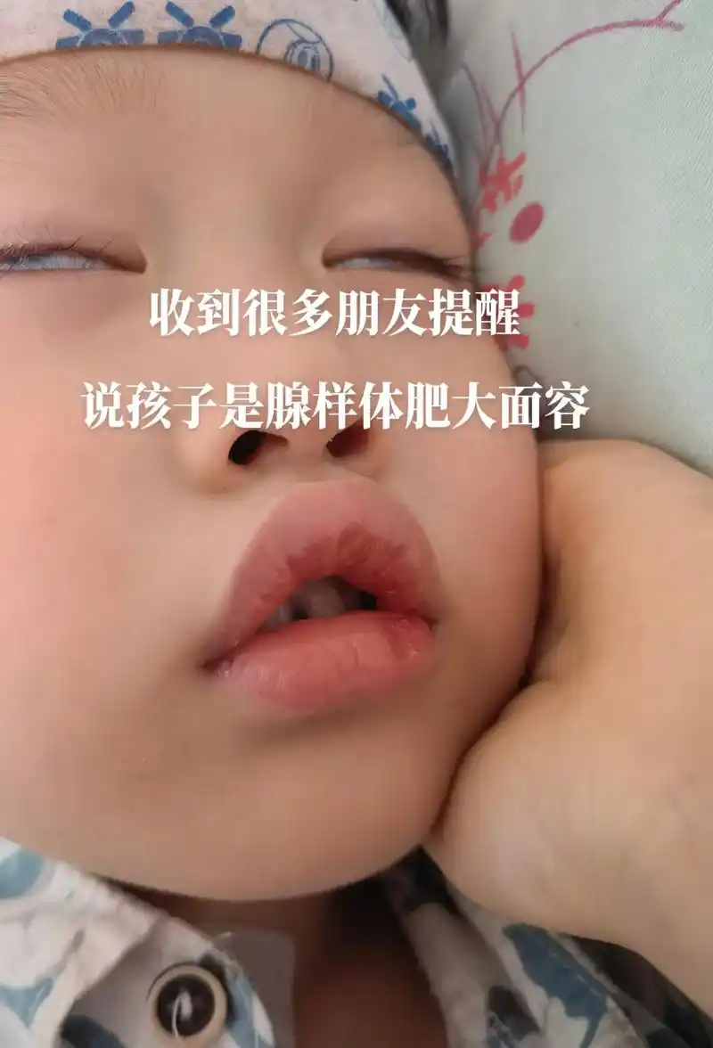 今天聊聊关于孩子#腺样体肥大 #腺样体肥大面容 #症状表现 张嘴呼吸