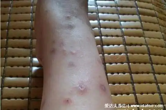 跳蚤咬的红疙瘩图片呈直线形或者三角形陈列