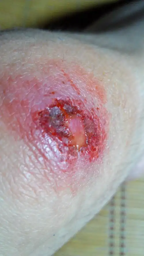 骑自行车擦伤了,具体如图所示.伤口有没有发炎呢?应该如何处理比较好