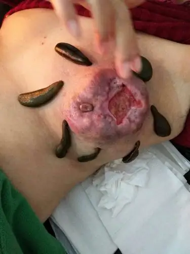 乳腺癌腋窝淋巴转移和淋巴转移一样吗