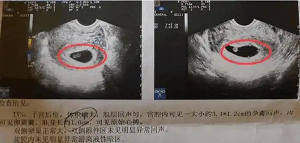 看清楚已生男孩阴超孕囊图片长这样图解茄子型胎囊数据