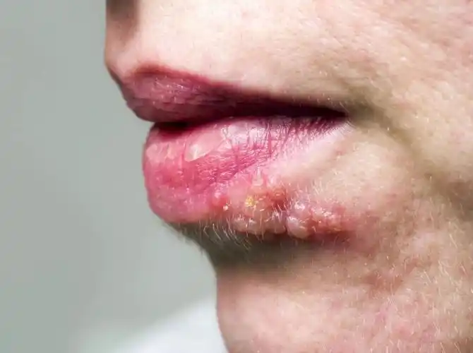 全球有4.17亿15-49岁的人(11%)罹患ii型单纯疱疹病毒感染.