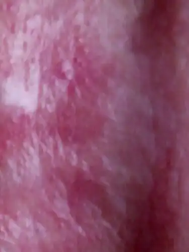 冠状沟发红疼痛瘙痒