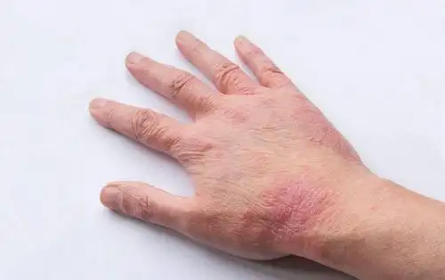 皲裂型湿疹你造吗?如何治疗更好?_皮肤