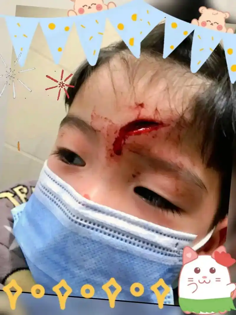 在幼儿园被其他小朋友撞倒了,摔到了乐高上面额头破了