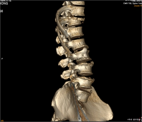 胸椎压缩性骨折