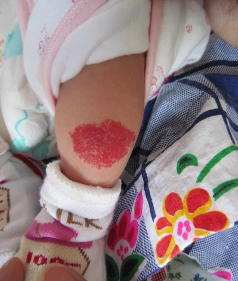 血管瘤消退后病变处皮肤可留有毛细血管扩张和色素沉着,一般是不会留