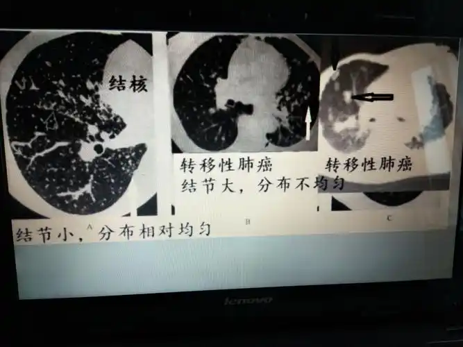 肺结核ct影像表现