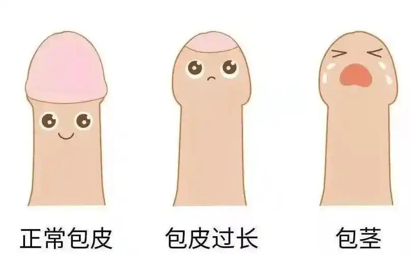 隐匿性阴茎是指原本正常长度的阴茎被埋藏于皮下或皮下脂肪之中,从