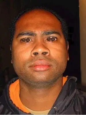 印度一男子长有"双瞳",被当地人称为"邪恶之眼"