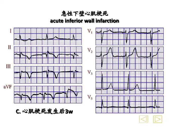 心电图2013最新课件6ppt