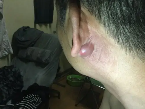 耳朵后面起个包是咋回事