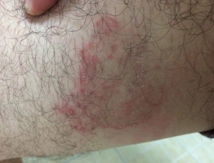 体股癣初期现象图片 (31)