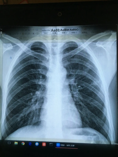 四年前得过肺结核,后治愈,要参加公务员体检了,帮忙看下这张胸片有没