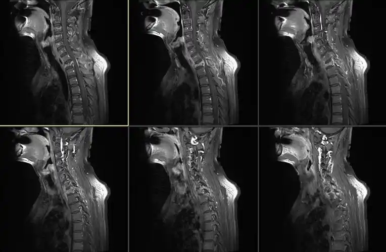 胸椎脊柱转移瘤胸1病例分享