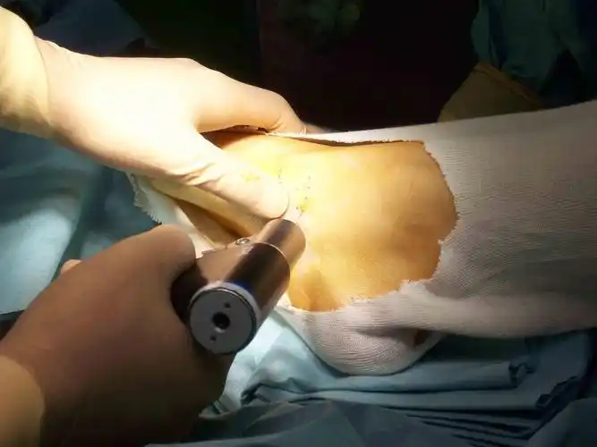 疼痛性附舟骨的手术治疗 - 好大夫在线