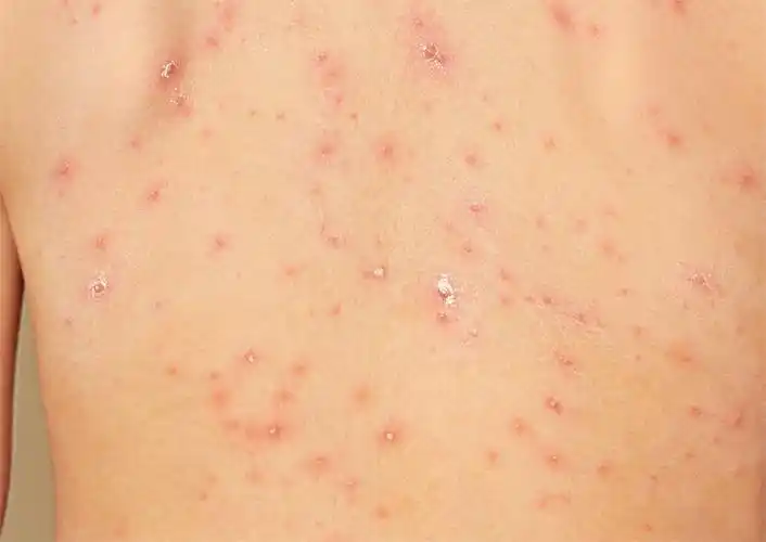 带状疱疹是由水痘-带状疱疹病毒引起的急性感染性皮肤病,一般是潜伏于