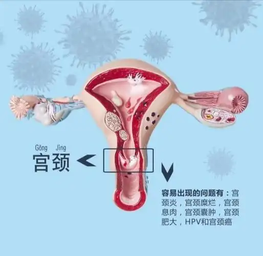 女性慢性宫颈炎的那些知识会引起哪些并发症