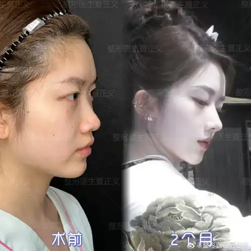 整形医生夏正义##夏正义鼻整形案例##钻石鼻