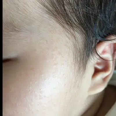 宝宝脸上有很多小疙瘩,这是什麼啊?