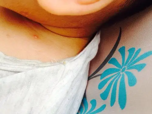 宝宝1岁2个月长了10几个软疣,怎么治疗?