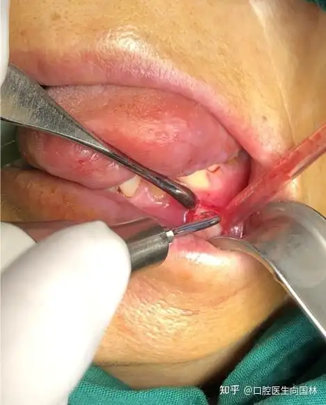 【囊肿手术案例】大型颌骨角化囊肿开窗减压联合囊肿塞治疗 - 知乎