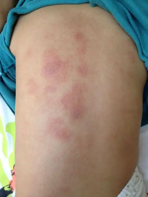 大人冷风疹的症状图片_有来医生