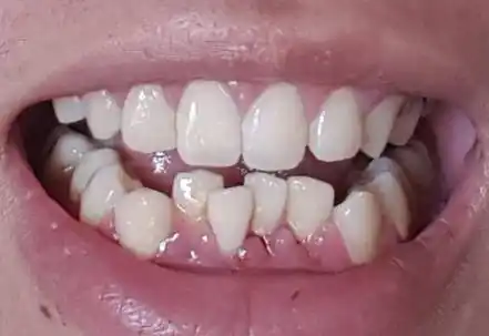 我下面这排有4颗牙齿不齐,可以矫正或者有什么办法搞齐吗?