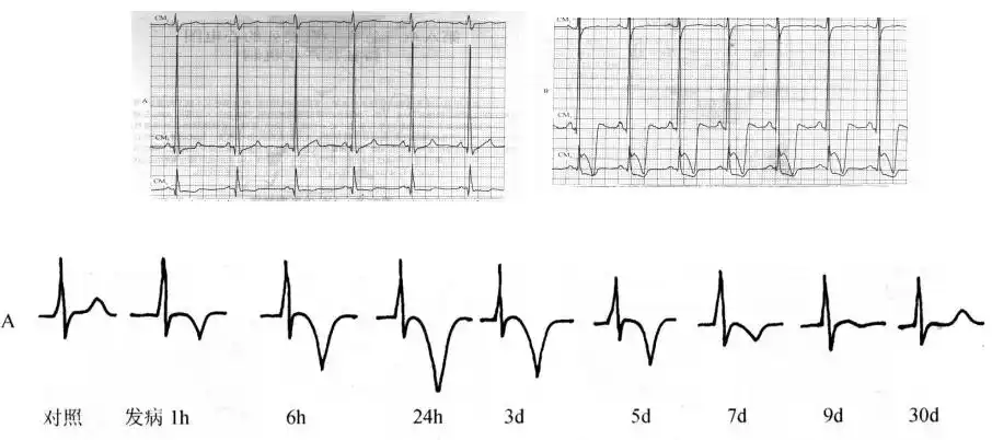 (3)持续性"冠状t波":心尖部肥厚心肌病