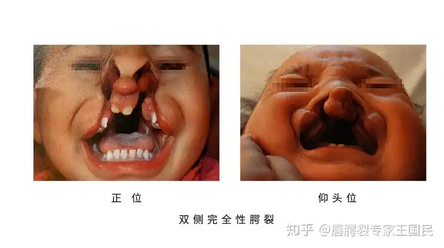 唇腭裂的临床分类