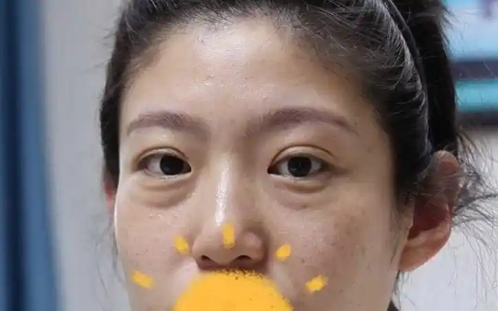 六年的大眼袋,伴随着苹果肌凹陷,做完之后太绝了!