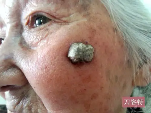 一例典型病例——皮角