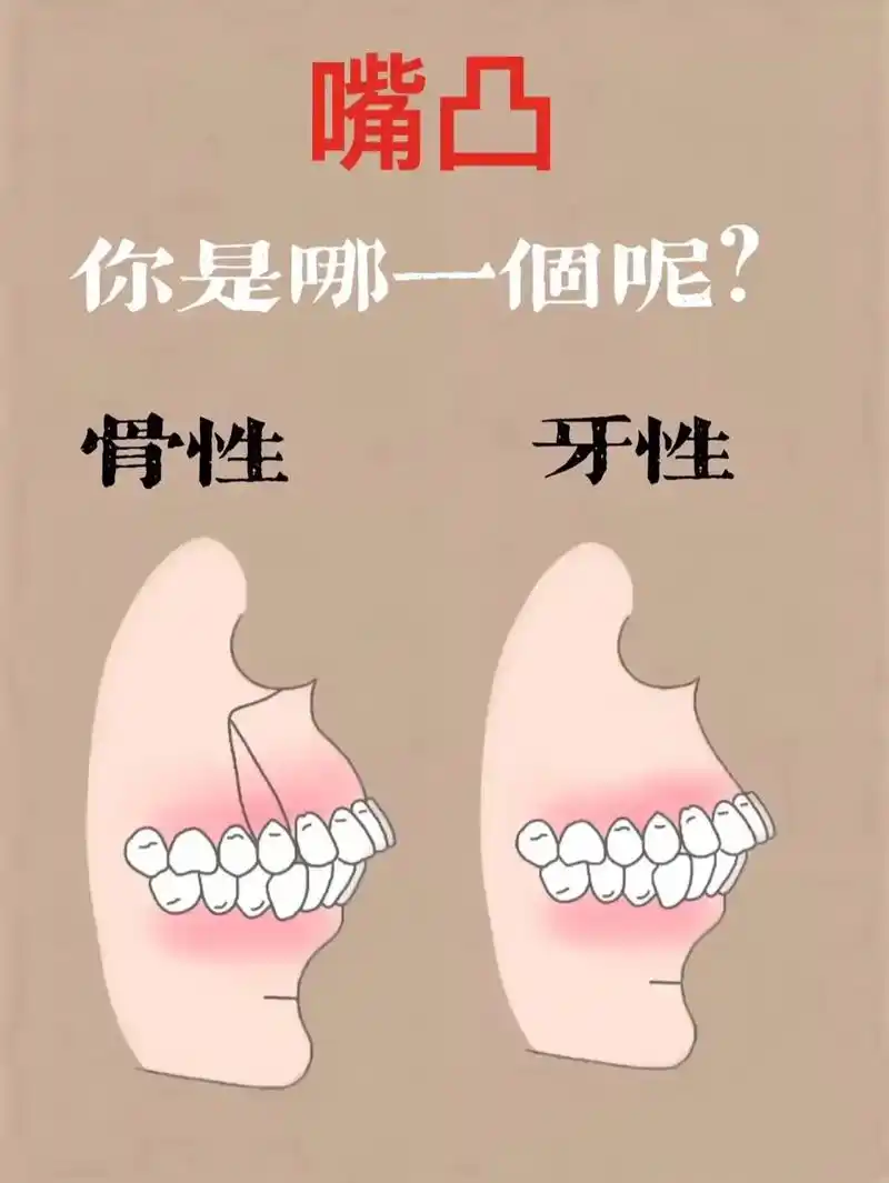 教一招自己在家测试.凸嘴是牙性还是骨性?是否 - 抖音