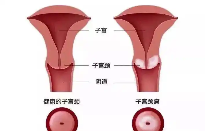 【婧氏舒芯宝】篇,宫颈疾病——女人最烦的妇科疾病!