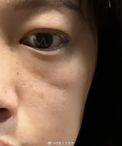 "印第安纹"有人可能会误以为是泪沟,但其实它位于泪沟下方,法令纹上方