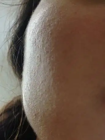 可能是自制珍珠粉牛奶面膜)皮肤过敏了 ,医生提到了溢脂性皮炎 (不