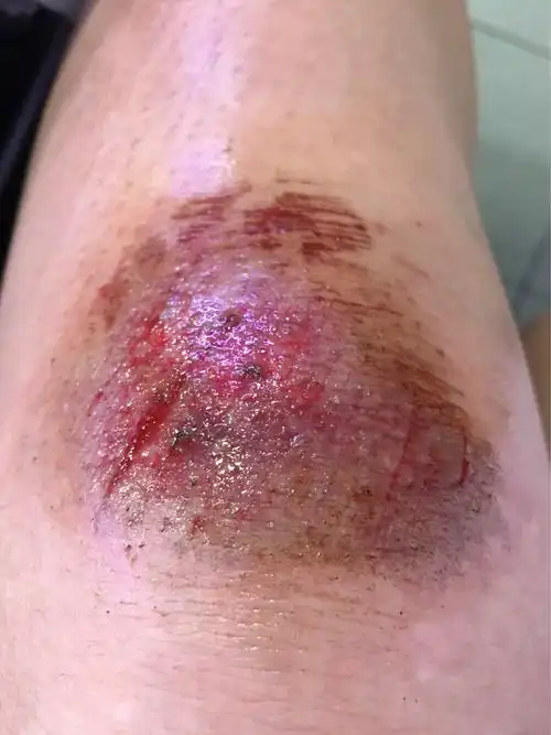 腿摔伤痛过程用油,经历的痛.