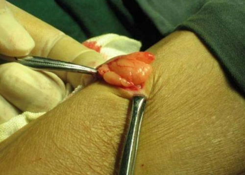 手臂皮下脂肪瘤图片