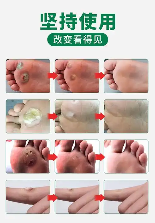 云南本草鸡眼膏去手足部脚底瘊子老茧肉刺根脚趾疣去疣灵鸡眼贴_帮您